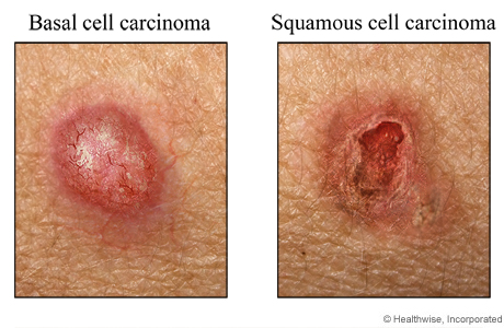 Basal And Squamous Cell Carcinoma Cigna