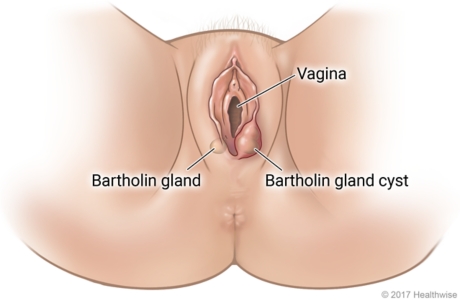 Bartholin Cyst Cysts Hot Sex Picture