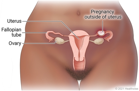 Female reproductive organs in pelvic area, including uterus, ovaries, and fallopian tubes, showing pregnancy outside uterus in fallopian tube.