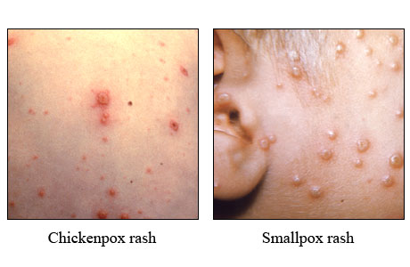 Chickenpox and smallpox rashes