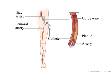 Location of the iliac artery, with detail of the catheter and guide wire inserted in the artery