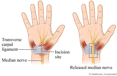 Open carpal tunnel release surgery