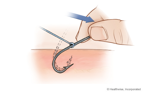 How to Remove a Fishing Hook from Your Finger 