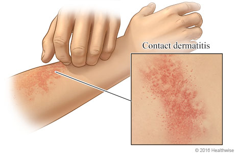 Contact dermatitis on an arm, with close-up of rash.