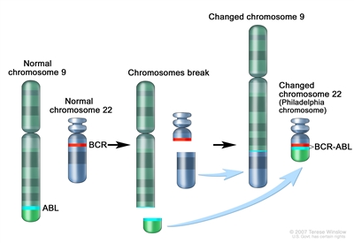 Philadelphia chromosome; three-panel drawing shows a piece of chromosome 9 and a piece of chromosome 22 breaking off and trading places, creating a changed chromosome 22 called the Philadelphia chromosome. In the left panel, the drawing shows a normal chromosome 9 with the ABL gene and a normal chromosome 22 with the BCR gene. In the center panel, the drawing shows chromosome 9 breaking apart in the ABL gene and chromosome 22 breaking apart below the BCR gene. In the right panel, the drawing shows chromosome 9 with the piece from chromosome 22 attached and chromosome 22 with the piece from chromosome 9 containing part of the ABL gene attached. The changed chromosome 22 with the BCR-ABLgene is called the Philadelphia chromosome.