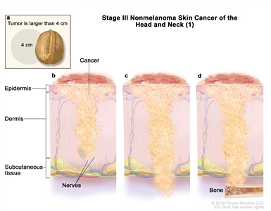 Stage III nonmelanoma skin cancer of the head and neck (1); drawing shows (a) an inset showing that the tumor is larger than 4 centimeters and that 4 centimeters is about the size of a walnut. Also shown is cancer spreading through the epidermis to (b) tissue covering the nerves below the dermis; (c) below the subcutaneous tissue; and (d) bone.
