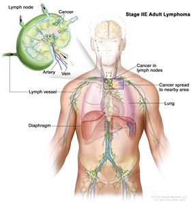 Stage IIE adult lymphoma; drawing shows cancer that has spread from a group of lymph nodes to a nearby area. Also shown is a lung and the diaphragm. An inset shows a lymph node with a lymph vessel, an artery, and a vein. Cancer cells are shown in the lymph node.