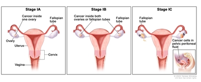 Three-panel drawing of stage IA, stage IB, and stage IC; each panel shows the ovaries, fallopian tubes, uterus, cervix, and vagina. The first panel (stage IA) shows cancer inside one ovary. The second panel (stage IB) shows cancer inside both ovaries. The third panel (stage IC) shows cancer inside both ovaries and (a) the tumor in the ovary shown on the left has ruptured (broken open), (b) there is cancer on the surface of the ovary shown on the right, and (c) there are cancer cells in the pelvic peritoneal fluid (inset).