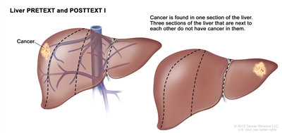 Liver PRETEXT and POSTTEXT I; drawing shows two livers. Dotted lines divide each liver into four vertical sections of about the same size. In the first liver, cancer is shown in the section on the far left. In the second liver, cancer is shown in the section on the far right.