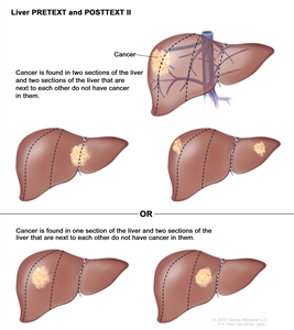 Liver PRETEXT and POSTTEXT II; drawing shows five livers. Dotted lines divide each liver into four vertical sections that are about the same size. In the first liver, cancer is shown in the two sections on the left. In the second liver, cancer is shown in the two sections on the right. In the third liver, cancer is shown in the far left and far right sections. In the fourth liver, cancer is shown in the second section from the left. In the fifth liver, cancer is shown in the second section from the right.