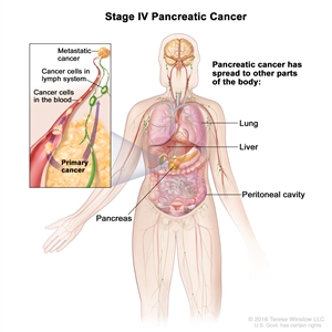 Stage IV pancreatic cancer; drawing shows other parts of the body where pancreatic cancer may spread, including the lung, liver, and peritoneal cavity. An inset shows cancer cells spreading from the pancreas, through the blood and lymph system, to another part of the body where metastatic cancer has formed.