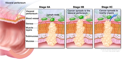 Stage II colorectal cancer; drawing shows a cross-section of the colon/rectum and a three-panel inset. Each panel shows the layers of the colon/rectum wall: the mucosa, submucosa, muscle layers, and serosa. Also shown are a blood vessel and lymph nodes. The first panel shows stage IIA with cancer in the mucosa, submucosa, muscle layers, and serosa. The second panel shows stage IIB with cancer in all layers and spreading through the serosa to the visceral peritoneum. The third panel shows stage IIC with cancer in all layers and spreading through the serosa to nearby organs.