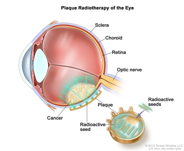 Plaque radiotherapy of the eye; drawing shows a cross-section of the eye. An inset shows a plaque with radioactive seeds; it is placed on the outside of the eye with the seeds aimed at the cancer. Also shown are the sclera, choroid, retina, and optic nerve.
