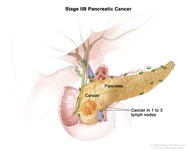 Stage IIB pancreatic cancer; drawing shows cancer in the pancreas and in 1 to 3 nearby lymph nodes.
