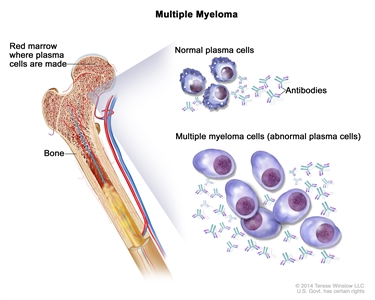 Multiple myeloma; drawing shows normal plasma cells, multiple myeloma cells (abnormal plasma cells), and antibodies. Also shown is red marrow inside bone, where plasma cells are made.