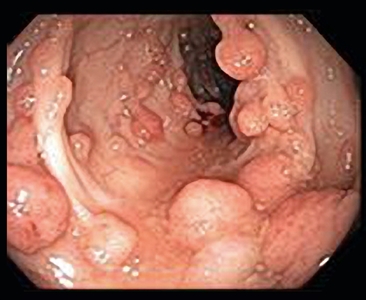 Many polyps protrude from the inner lining of the colon.