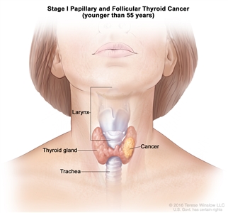 Stage I papillary and follicular thyroid cancer in patients younger than 55 years; drawing shows cancer in the thyroid gland. Also shown are the larynx and trachea.