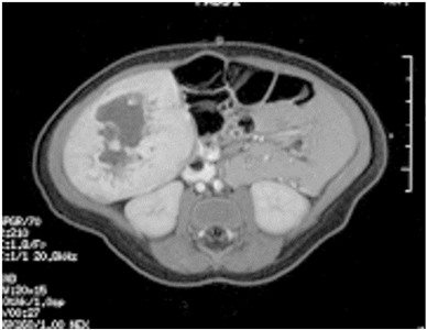 MRI image of a single liver lesion (intrahepatic congenital hemangioma).