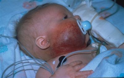 Photograph showing a Kaposiform hemangioendothelioma lesion on the right side of the face and neck.