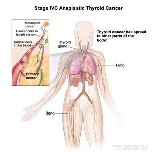 Stage IVC anaplastic thyroid cancer; drawing shows other parts of the body where thyroid cancer may spread, including the lung and bone. An inset shows cancer cells spreading from the thyroid, through the blood and lymph system, to another part of the body where metastatic cancer has formed.
