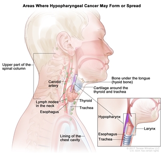 Drawing shows areas where hypopharyngeal cancer may form or spread, including the bone under the tongue (hyoid bone), cartilage around the thyroid and trachea, the thyroid, the trachea, and the esophagus. Also shown are the upper part of the spinal column, the carotid artery, lymph nodes in the neck, and lining of the chest cavity. An inset shows a cross section of the hypopharynx, larynx, esophagus, and trachea.