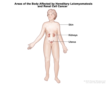Drawing showing areas of the body affected by hereditary leiomyomatosis and renal cell cancer, including the skin, kidneys, and uterus.