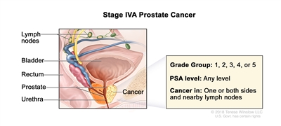 Stage IVA prostate cancer; drawing shows cancer in one side of the prostate and in nearby lymph nodes. The PSA can be any level and the Grade Group is 1 ,2, 3, 4, or 5. Also shown are the bladder, rectum, and urethra.