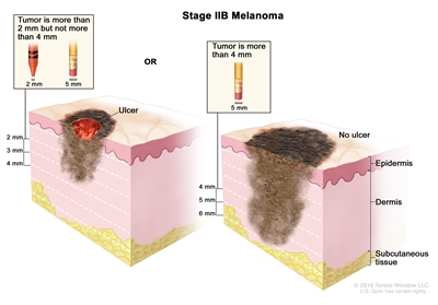 Two-panel drawing of stage IIB melanoma; the panel on the left shows a tumor that is more than 2 but not more than 4 millimeters thick, with ulceration (a break in the skin). The panel on the right shows a tumor that is more than 4 millimeters thick, without ulceration. Also shown are the epidermis (outer layer of the skin), the dermis (inner layer of the skin), and the subcutaneous tissue below the dermis.
