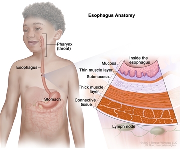 Anatomy of the esophagus; drawing shows the pharynx (throat), esophagus, and stomach. A pullout shows the mucosa layer, thin muscle layer, submucosa layer, thick muscle layer, and connective tissue layer of the esophagus wall. The lymph nodes are also shown.
