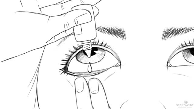 Here's Help: How to Give Yourself Eyedrops or Eye Ointment