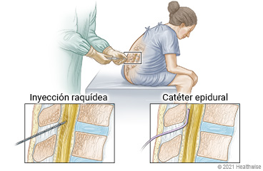 El médico introduce una aguja cerca de la médula espinal en la espalda de una persona sentada, con detalles del sitio de la inyección raquídea y de la colocación del catéter epidural.