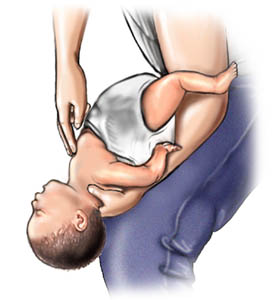Imagen del procedimiento de rescate para el atragantamiento (maniobra de Heimlich) con el bebé boca arriba