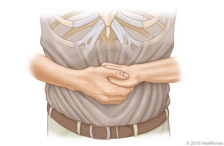 Imagen A: Vista frontal de la posición de las manos para la maniobra de Heimlich en un adulto o un niño