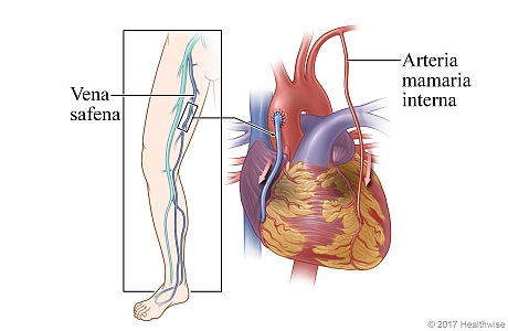Ubicación de la vena safena en la pierna, y el corazón que muestra la vena safena y una arteria mamaria interna utilizada para sortear la arteria coronaria enferma