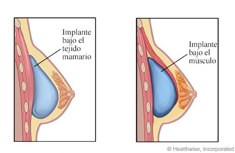 Implante de seno bajo el tejido mamario e implante bajo el músculo.