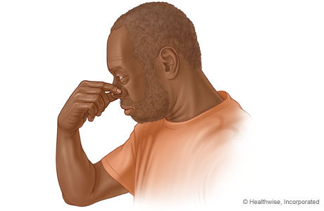 Hombre apretándose la nariz para detener una hemorragia nasal