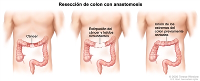 La ilustración a tres paneles muestra una cirugía de cáncer de colon con anastomosis; el primer panel muestra el área del colon con cáncer, el panel del medio muestra la extirpación del cáncer y el tejido circundante, el último panel muestra la unión de los extremos del colon.