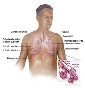 Anatomía del aparato respiratorio. En la imagen se muestra el pulmón derecho con los lóbulos superior, medio e inferior; el pulmón izquierdo con los lóbulos superior e inferior; así como la tráquea, los bronquios, los ganglios linfáticos y el diafragma. En el recuadro se muestran los bronquiolos, los alvéolos, una arteria y una vena.