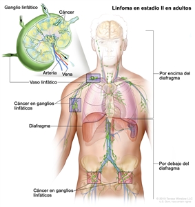 Linfoma en estadio II en adultos. En la imagen se observa cáncer en 2 grupos de ganglios linfáticos encima del diafragma y en 2 grupos de ganglios linfáticos debajo del diafragma. En una ampliación, se muestran un ganglio linfático, un vaso linfático, una arteria y una vena. Se observan células cancerosas en el ganglio linfático.