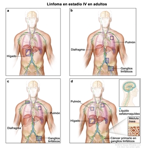 Linfoma en estadio IV en adultos. En la imagen se observan cuatro paneles: a) en el panel superior izquierdo, se observa cáncer en el hígado; b) en el panel superior derecho, se observa cáncer en el pulmón izquierdo y en 2 grupos de ganglios linfáticos debajo del diafragma; c) en el panel inferior izquierdo, se observa cáncer en el pulmón izquierdo y en grupos de ganglios linfáticos encima y debajo del diafragma; d) en el panel inferior derecho, se observa cáncer en ambos pulmones, el hígado y, en un recuadro, cáncer en la médula ósea. También se muestran, cáncer primario en los ganglios linfáticos; y en un recuadro, el encéfalo y el líquido cefalorraquídeo (en azul).