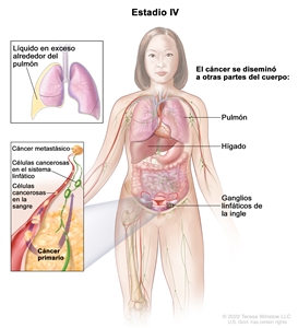 La figura del estadio IV muestra partes del cuerpo hacia donde se puede diseminar el cáncer de ovario, incluso el pulmón, el hígado y los ganglios linfáticos de la ingle. En un recuadro de la parte superior, se observan líquido en exceso alrededor del pulmón. En un recuadro de la parte inferior, se observa células cancerosas diseminándose a través de la sangre y el sistema linfático hacia otras partes del cuerpo donde se formó el cáncer metastásico.