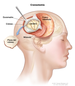 En la imagen de una craneotomía se observa que se levantó una sección del cuero cabelludo para extraer una pieza del cráneo; se abrió la duramadre que cubre el cerebro para exponer el cerebro. También se muestra la capa de músculo debajo del cuero cabelludo.