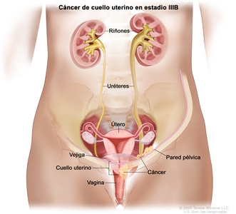 Cáncer de cuello uterino en estadio IIIB. En la imagen se observa cáncer en el cuello uterino y la pared pélvica. También se muestra cáncer que obstruye el uréter derecho, y agrandamiento del uréter y el riñón derechos. Además, se observan el útero, la vejiga y la vagina.