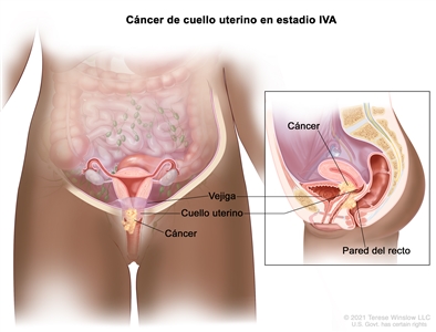 Cáncer de cuello uterino en estadio IVA. En la imagen y en el recuadro se observa cáncer que se diseminó del cuello uterino a la vejiga y la pared del recto.