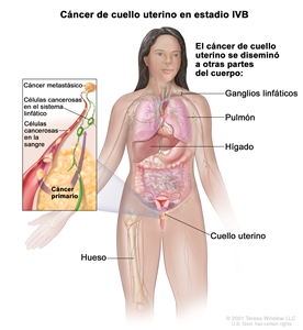 Cáncer de cuello uterino en estadio IVB. En la imagen se observan otras partes del cuerpo donde es posible que el cáncer de cuello uterino se disemine, como los ganglios linfáticos, el pulmón, el hígado y el hueso. En el recuadro se muestran células cancerosas que se diseminan desde el cuello uterino, a través de la sangre y el sistema linfático, a otras partes del cuerpo donde se formó el cáncer metastásico.