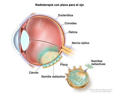 Radioterapia con placa para el ojo. En la imagen se observa una sección transversal del ojo. En un recuadro se muestra una placa con semillas radiactivas que se coloca en el exterior del ojo de manera que las semillas apuntan hacia el cáncer. También se muestran la esclerótica, la coroides, la retina y el nervio óptico.