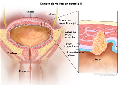 Cáncer de vejiga en estadio ll (cáncer de vejiga con invasión muscular). En la imagen se observan la vejiga, el uréter, la próstata y la uretra. En el recuadro se muestra el cáncer en el revestimiento interno de la vejiga, el tejido conjuntivo y las capas de tejido muscular. También se observa la capa de grasa que la rodea.