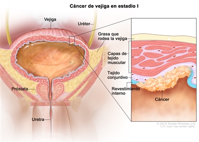 Cáncer de vejiga en estadio l (cáncer de vejiga sin invasión muscular). En la imagen se observan la vejiga, el uréter, la próstata y la uretra. En el recuadro se muestra el cáncer en el revestimiento interno de la vejiga y en el tejido conjuntivo. También se observan las capas de tejido muscular de la vejiga y la capa de grasa que la rodea.
