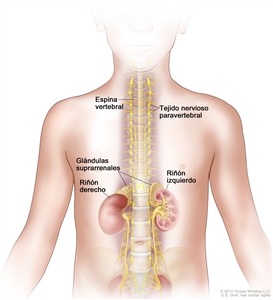 En el dibujo se observan las partes del cuerpo donde se puede encontrar un neuroblastoma, como el tejido nervioso paravertebral y las glándulas suprarrenales. También se muestran la espina vertebral, y los riñones derecho e izquierdo.