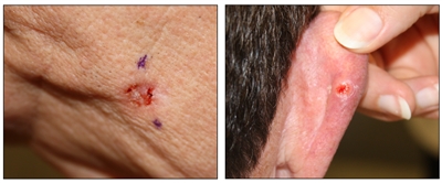 Se observan dos fotografías. En el recuadro de la izquierda se muestra una lesión cutánea ulcerada de color rojo en la cara, y en el recuadro de la derecha se muestra una lesión cutánea ulcerada de color rojo rodeada por un borde blanco en la parte posterior de la oreja.